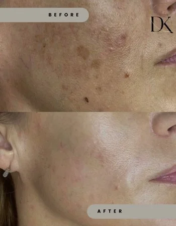 Фотоомолодження IPL Lumecca-341