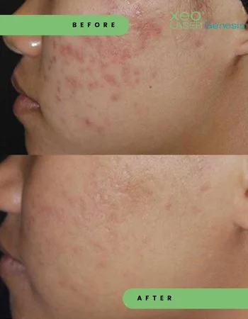 Лазерне омолодження Cutera Derma Genesis-479