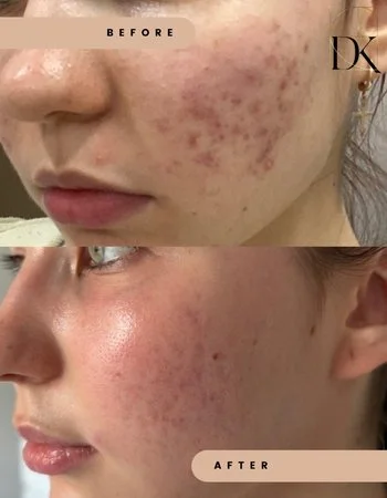 Лікування акне-335