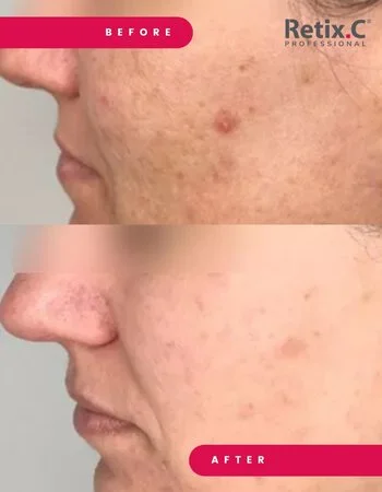 Хімічні пілінги Retix.C-470