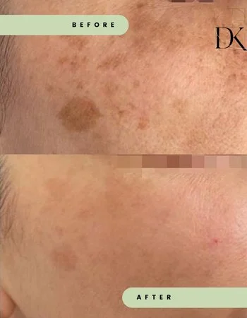 Видалення пігментних плям Cutera LimeLight-431