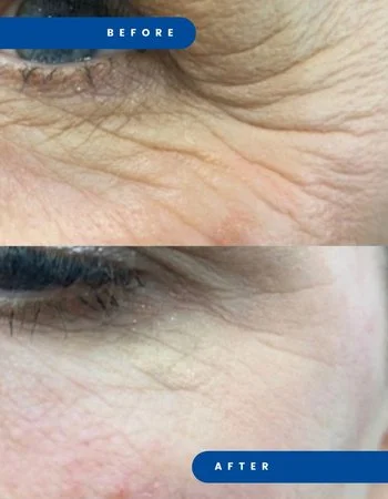 Полімолочна кислота Juvelook & Lenisna-299