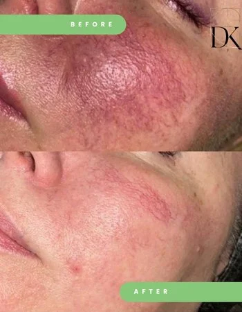 Лазерне видалення судин Cutera Laser Vascular-506