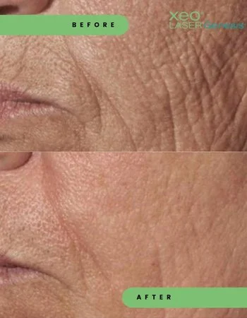 Лазерне омолодження Cutera Derma Genesis-488