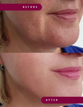 Полімолочна кислота Juvelook & Lenisna-302