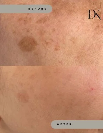 Фотоомолодження IPL Lumecca-350