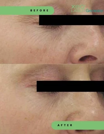 Лазерне омолодження Cutera Derma Genesis-491