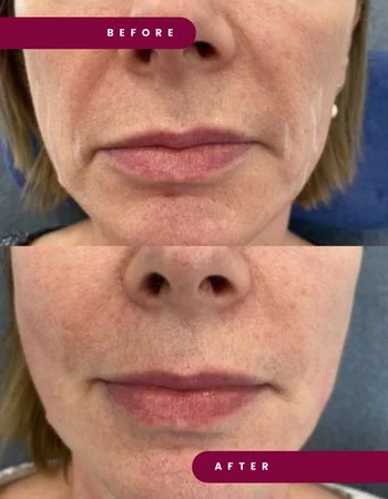 Полімолочна кислота Juvelook & Lenisna-305