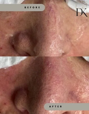 Фотоомолодження IPL Lumecca-353