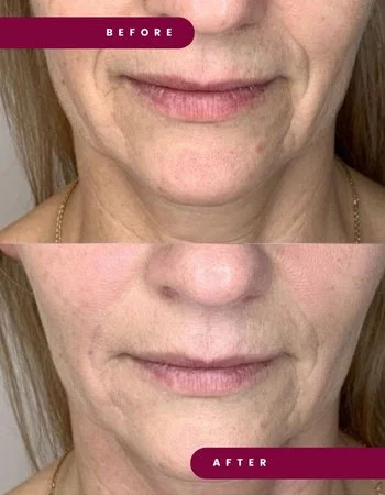 Полімолочна кислота Juvelook & Lenisna-308