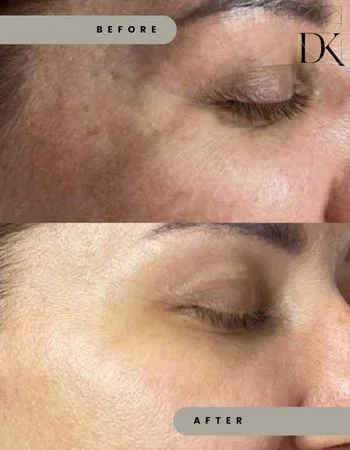 Фотоомолодження IPL Lumecca-356