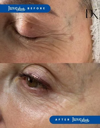 Полімолочна кислота Juvelook & Lenisna-497