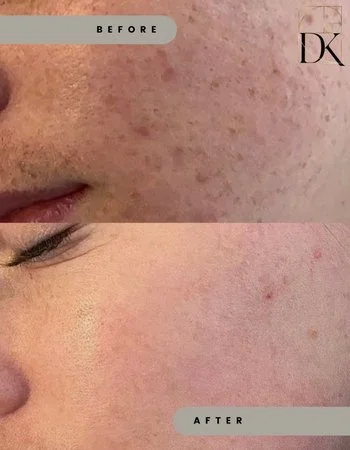 Фотоомолодження IPL Lumecca-338