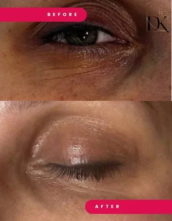 Хімічні пілінги Retix.C-467