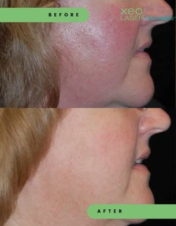 Лазерне омолодження Cutera Derma Genesis-476