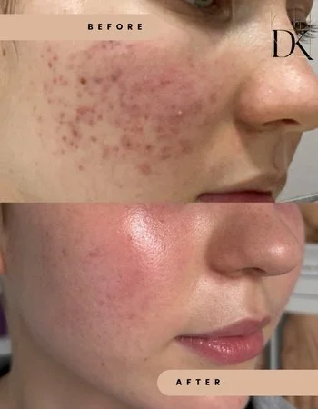 Лікування акне-332