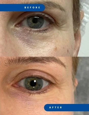 Полімолочна кислота Juvelook & Lenisna-534