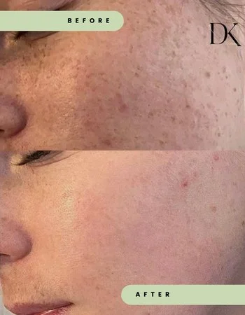 Видалення пігментних плям Cutera LimeLight-428