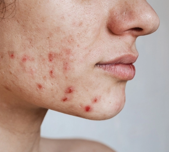 Лікування акне tab-108