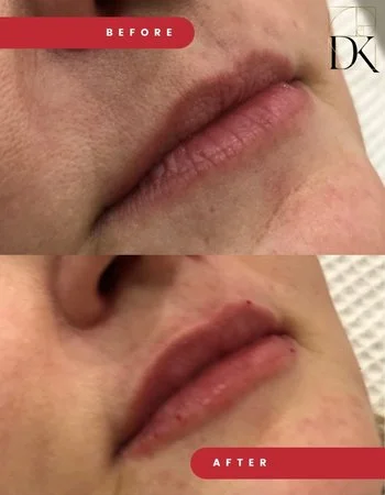 Контурна пластика губ Belotero-710