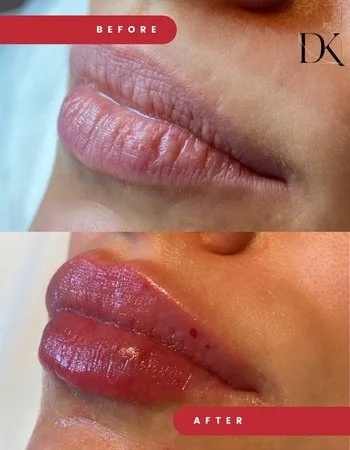 Контурна пластика губ Belotero-737