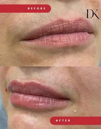 Контурна пластика губ Belotero-740