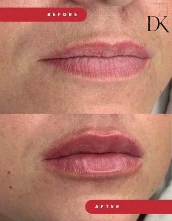 Контурна пластика губ Belotero-719