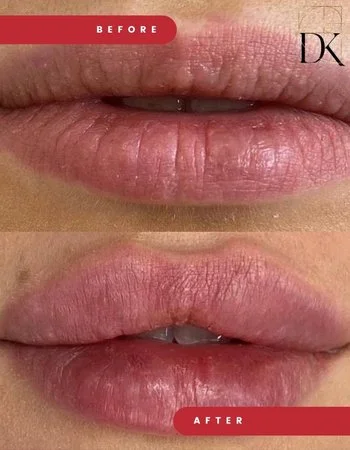 Контурна пластика губ Belotero-728