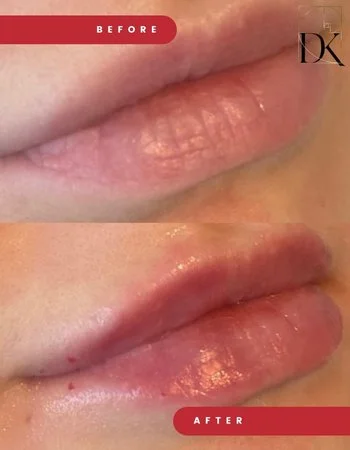 Контурна пластика губ Belotero-731