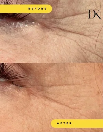 Бланшинг Belotero-743