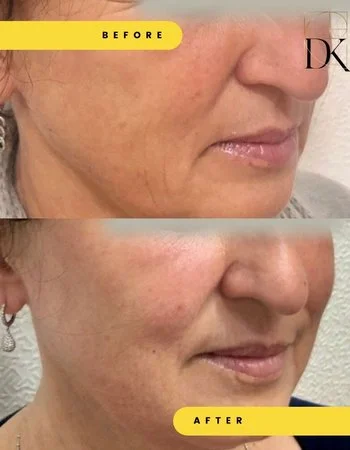 Бланшинг Belotero-749