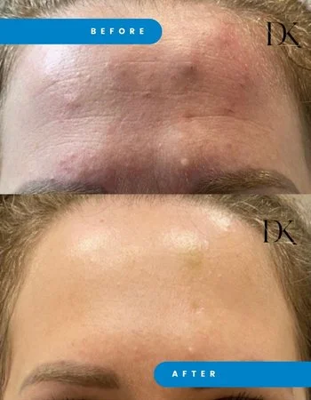 Ботулінотерапія Xeomin - Botox-758