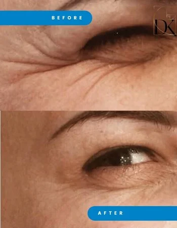 Ботулінотерапія Xeomin - Botox-767