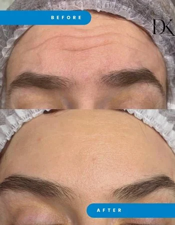 Ботулінотерапія Xeomin - Botox-770