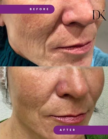 Контурна пластика обличчя Belotero-755