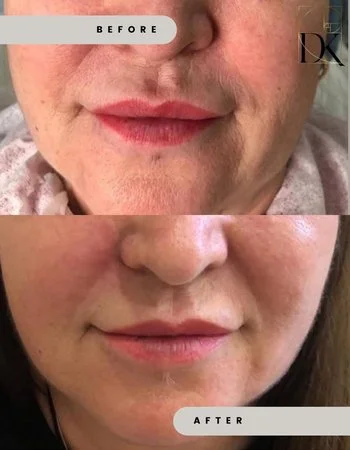 Мікроголковий RF-Ліфтинг Morpheus-8-634