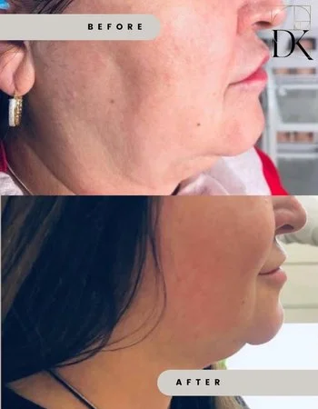 Мікроголковий RF-Ліфтинг Morpheus-8-637