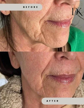 Мікроголковий RF-Ліфтинг Morpheus-8-640