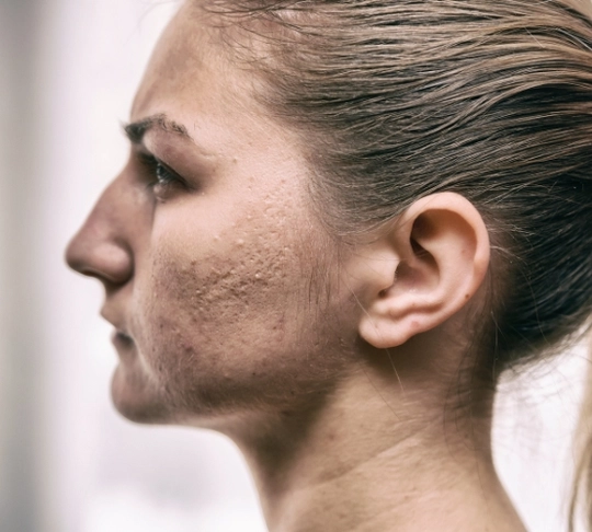 Лікування постакне tab-126