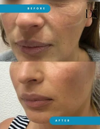 Векторний ліфтинг Radiesse-671