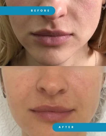 Векторний ліфтинг Radiesse-674