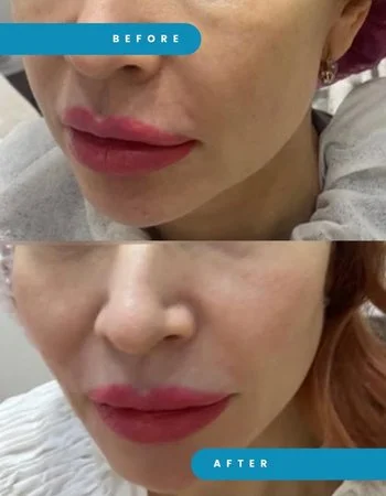 Векторний ліфтинг Radiesse-677