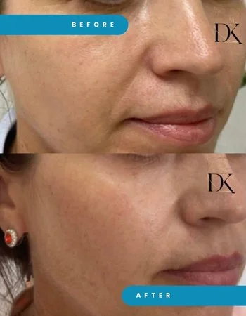 Векторний ліфтинг Radiesse-683