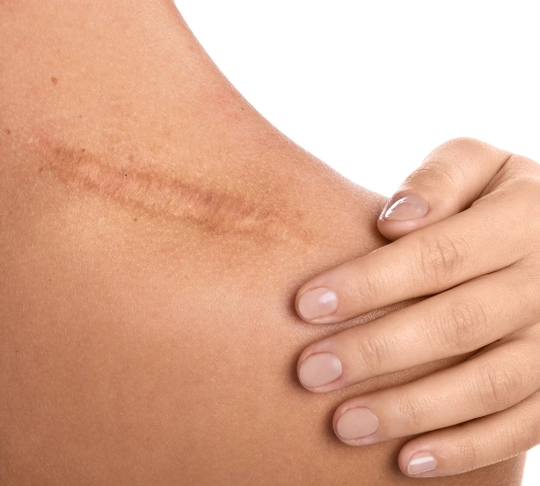 Лазерне видалення рубців і шрамів-111