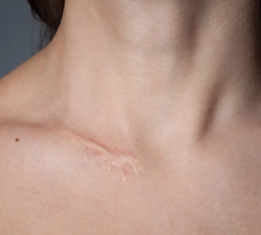 Лазерне видалення рубців і шрамів tab-111