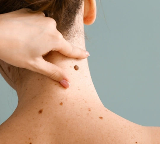 Видалення новоутворень-31