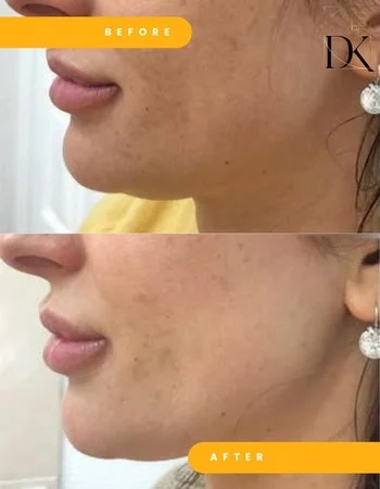 SMAS ліфтинг Ulthera System-650