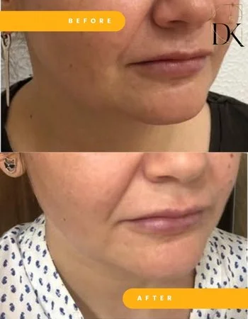 SMAS ліфтинг Ulthera System-653