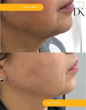 SMAS ліфтинг Ulthera System-659