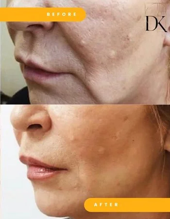 SMAS ліфтинг Ulthera System-662